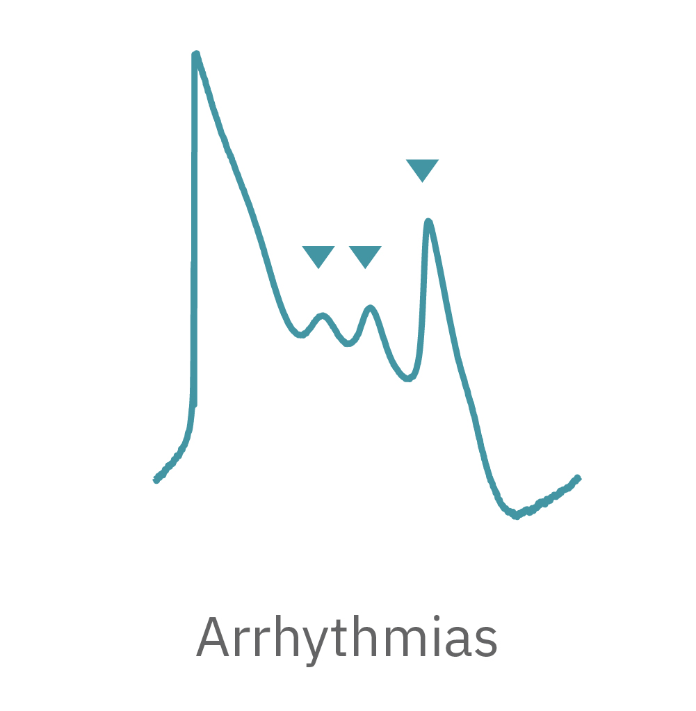 Arrythmias