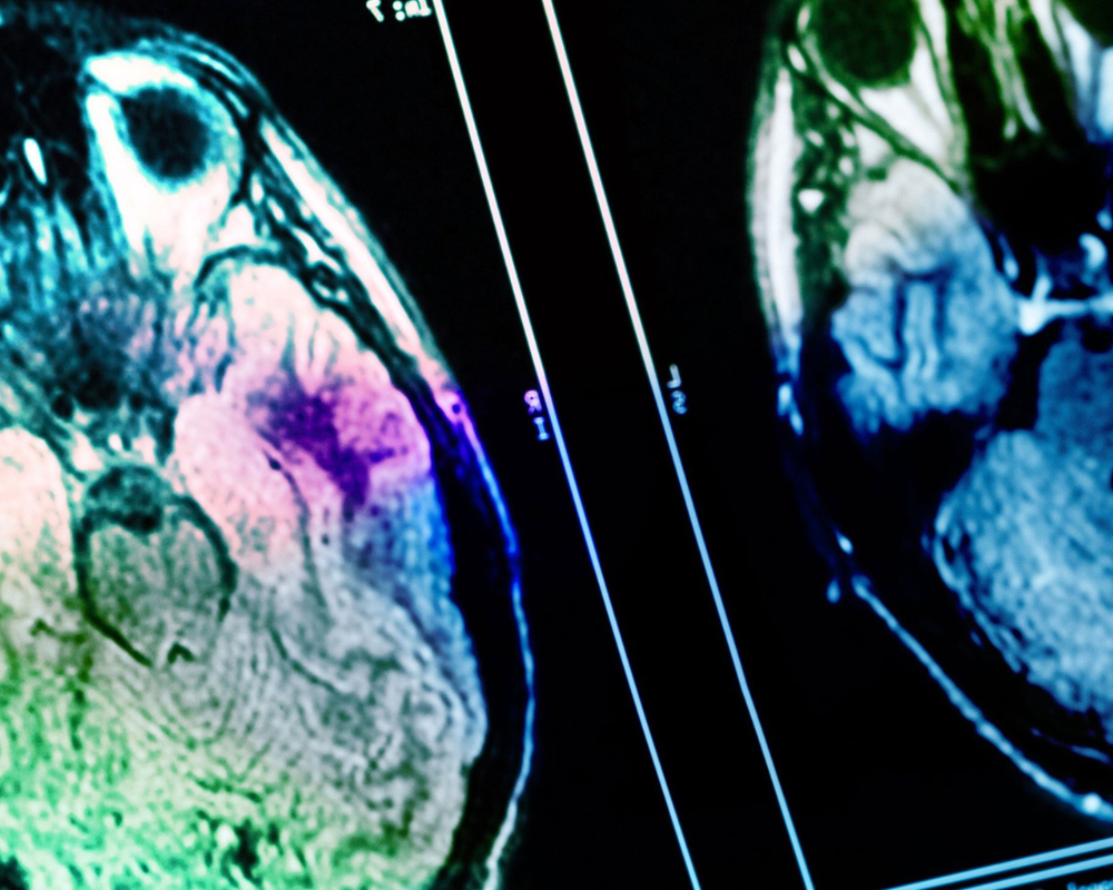 Neurological Disease Application