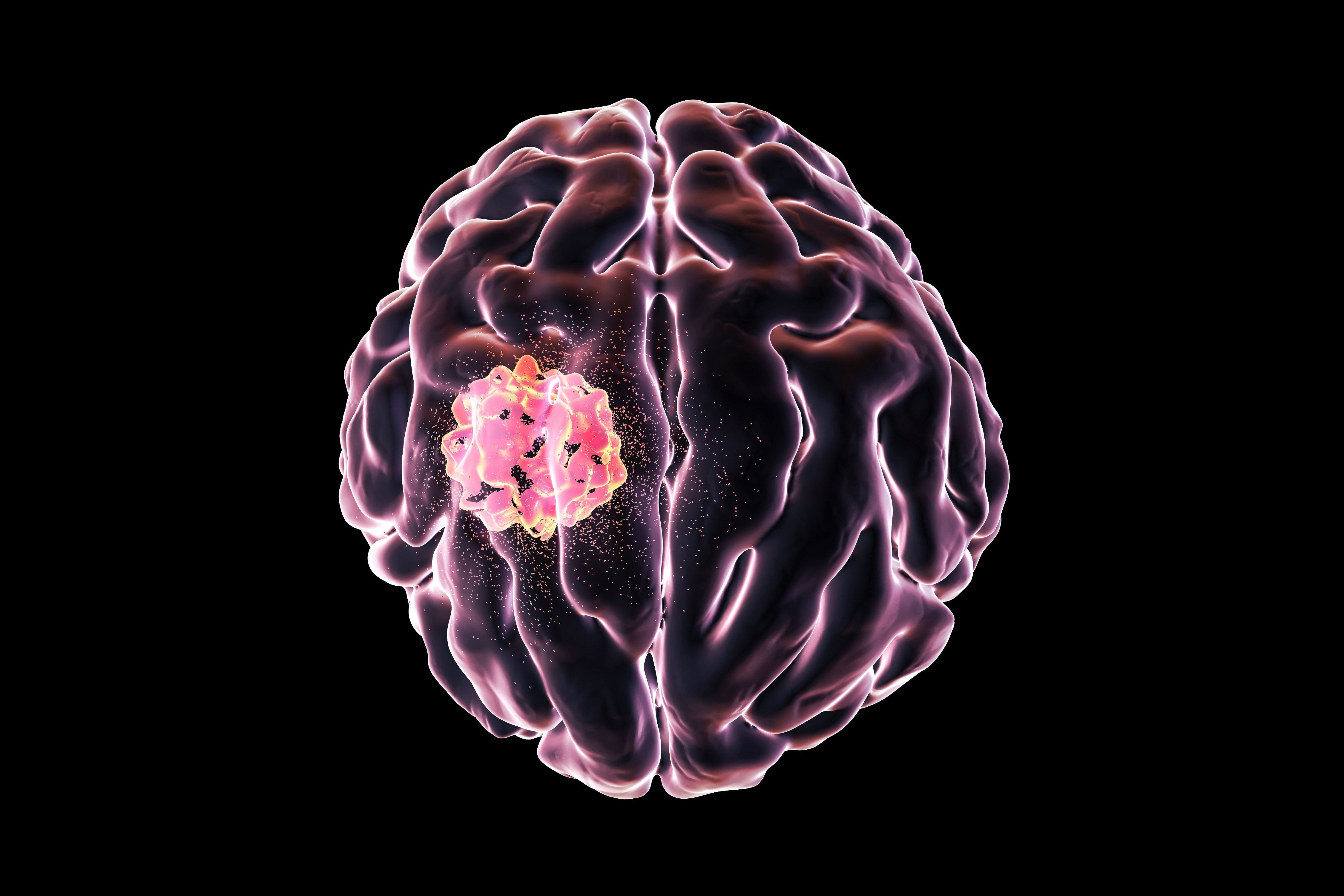 Glioma Application