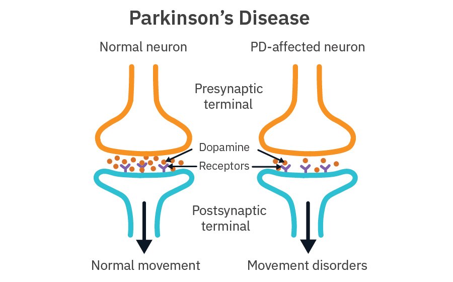 Parkinson's Disease Infographic