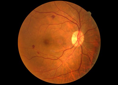 View of the back of a retina